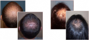 Before and After Using Provillus Hair Loss Treatment